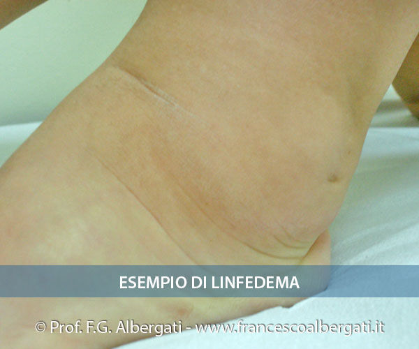 Linfedema