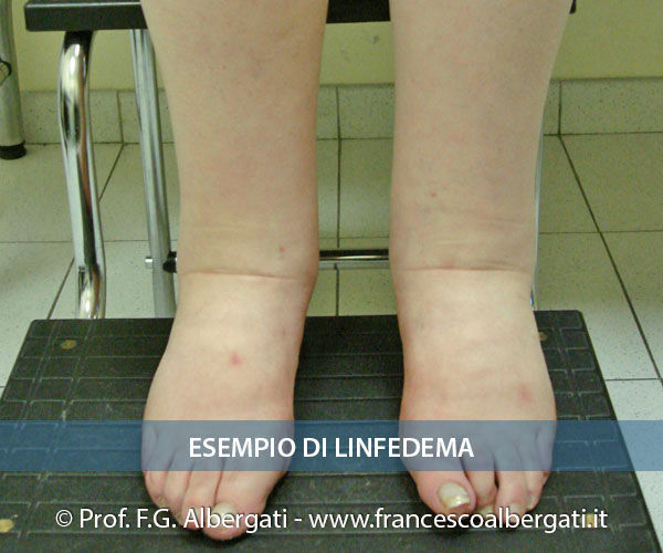 Linfedema