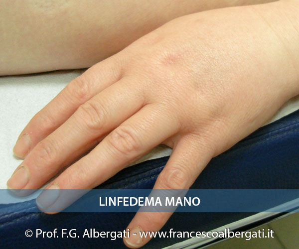 Linfedema alla mano